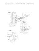 IMPLANT SYSTEM HAVING A MULTIFUNCTIONAL INSERTER AND COMPLEMENTARY IMPLANT diagram and image