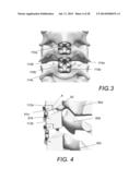 SYSTEM AND METHOD FOR A SPINAL STABILIZATION IMPLANT ASSEMBLY diagram and image