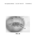 MEDICAL TUBES AND METHODS OF MANUFACTURE diagram and image