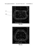 METHODS FOR OPTIMIZING AND EVALUATING DOSE DISTRIBUTIONS IN BRACHYTHERPAY diagram and image