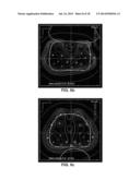 METHODS FOR OPTIMIZING AND EVALUATING DOSE DISTRIBUTIONS IN BRACHYTHERPAY diagram and image