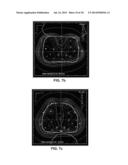 METHODS FOR OPTIMIZING AND EVALUATING DOSE DISTRIBUTIONS IN BRACHYTHERPAY diagram and image