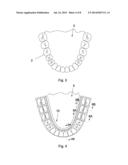 ORAL TRANSMUCOSAL DRUG DELIVERY DEVICE diagram and image