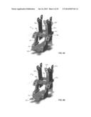 ADJUSTABLE ALLOGRAFT TEMPLATES AND METHODS OF USE diagram and image