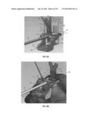 ADJUSTABLE ALLOGRAFT TEMPLATES AND METHODS OF USE diagram and image