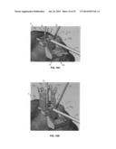 ADJUSTABLE ALLOGRAFT TEMPLATES AND METHODS OF USE diagram and image