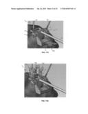 ADJUSTABLE ALLOGRAFT TEMPLATES AND METHODS OF USE diagram and image