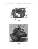 ADJUSTABLE ALLOGRAFT TEMPLATES AND METHODS OF USE diagram and image