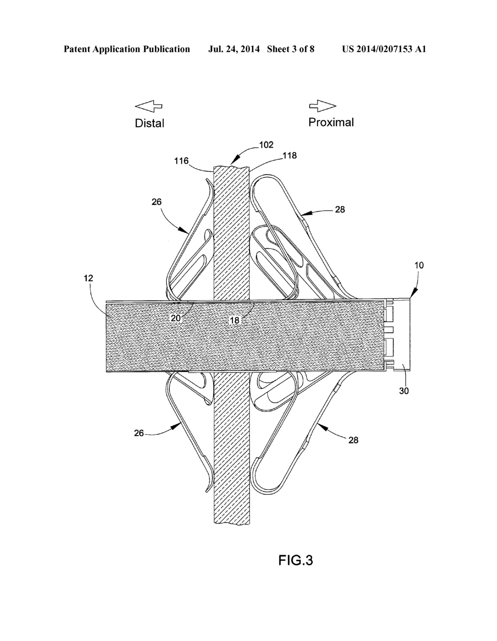 DELIVERY SYSTEM, METHOD, AND ANCHOR FOR MEDICAL IMPLANT PLACEMENT - diagram, schematic, and image 04