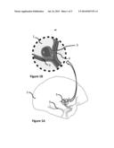 ANEURYSM CLOSURE CLIP diagram and image