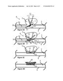 ANEURYSM CLOSURE CLIP diagram and image