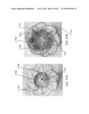 Sealing Device and Delivery System diagram and image