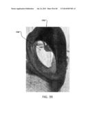 Sealing Device and Delivery System diagram and image