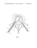 SURGICAL SYSTEM AND METHODS OF USE diagram and image