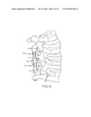 TOOLS FOR IMPLANTATION OF INTERSPINOUS IMPLANTS AND METHODS THEROF diagram and image