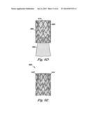 Venous Valve Apparatus, System, and Method diagram and image