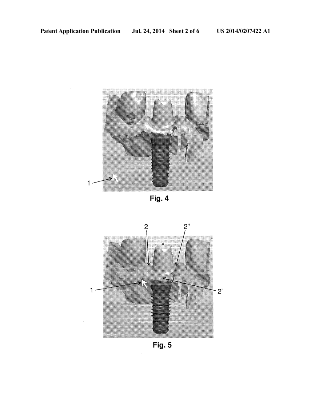 TOOLS FOR CUSTOMIZED DESIGN OF DENTAL RESTORATIONS - diagram, schematic, and image 03