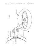 SYSTEM AND METHOD FOR PROCEDURAL CG EYE MENISCUS diagram and image