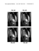 De-noising of Real-time Dynamic Magnetic Resonance Images by the Combined     Application of Karhunen-Loeve Transform (KLT) and Wavelet Filtering diagram and image