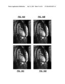 De-noising of Real-time Dynamic Magnetic Resonance Images by the Combined     Application of Karhunen-Loeve Transform (KLT) and Wavelet Filtering diagram and image