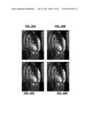 De-noising of Real-time Dynamic Magnetic Resonance Images by the Combined     Application of Karhunen-Loeve Transform (KLT) and Wavelet Filtering diagram and image