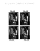 De-noising of Real-time Dynamic Magnetic Resonance Images by the Combined     Application of Karhunen-Loeve Transform (KLT) and Wavelet Filtering diagram and image