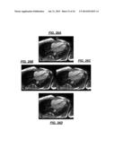 De-noising of Real-time Dynamic Magnetic Resonance Images by the Combined     Application of Karhunen-Loeve Transform (KLT) and Wavelet Filtering diagram and image