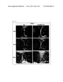 SCREENING METHOD FOR THERAPEUTIC AGENT FOR CHONDROPATHY AND MODIFIED     CHONDROCYTE FOR TREATMENT OF CHONDROPATHY diagram and image