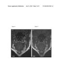 MEDICINAL COSMETIC LIPOATROPHY diagram and image