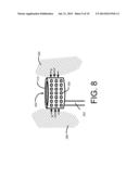 TISSUE SENSING DEVICE FOR SUTURELESS VALVE SELECTION diagram and image