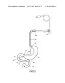 GASTROINTESTINAL PROSTHESES diagram and image