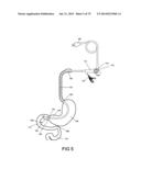 GASTROINTESTINAL PROSTHESES diagram and image