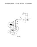 GASTROINTESTINAL PROSTHESES diagram and image