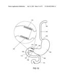 GASTROINTESTINAL PROSTHESES diagram and image