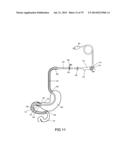 GASTROINTESTINAL PROSTHESES diagram and image