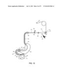 GASTROINTESTINAL PROSTHESES diagram and image