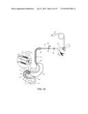 GASTROINTESTINAL PROSTHESES diagram and image