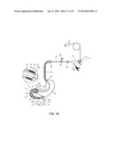 GASTROINTESTINAL PROSTHESES diagram and image