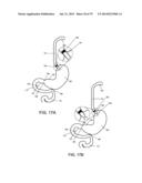 GASTROINTESTINAL PROSTHESES diagram and image