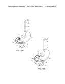 GASTROINTESTINAL PROSTHESES diagram and image