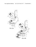 GASTROINTESTINAL PROSTHESES diagram and image