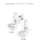 GASTROINTESTINAL PROSTHESES diagram and image