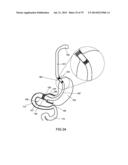 GASTROINTESTINAL PROSTHESES diagram and image