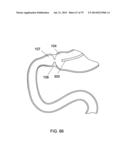 GASTROINTESTINAL PROSTHESES diagram and image