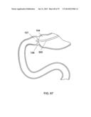 GASTROINTESTINAL PROSTHESES diagram and image