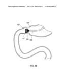 GASTROINTESTINAL PROSTHESES diagram and image