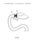 GASTROINTESTINAL PROSTHESES diagram and image