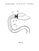 GASTROINTESTINAL PROSTHESES diagram and image