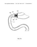 GASTROINTESTINAL PROSTHESES diagram and image