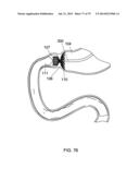 GASTROINTESTINAL PROSTHESES diagram and image